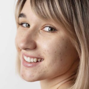 bespoke acne more treatments