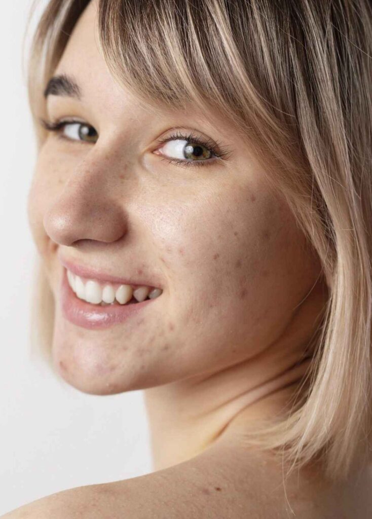 bespoke acne treatment