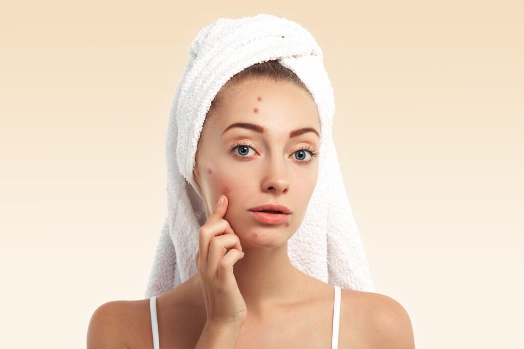 Remove Acne Scars