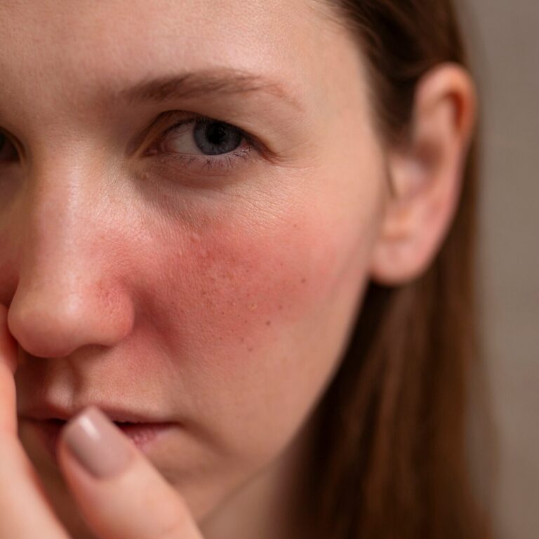 ROSACEA