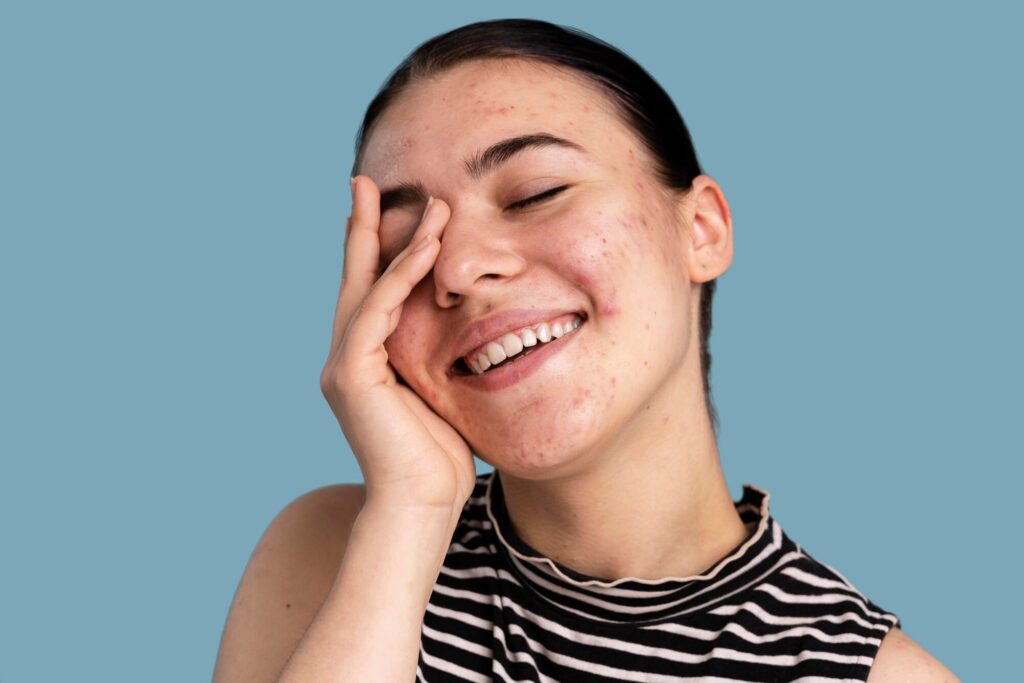 How to Remove Blackheads? A Complete Guide to Clearer Skin