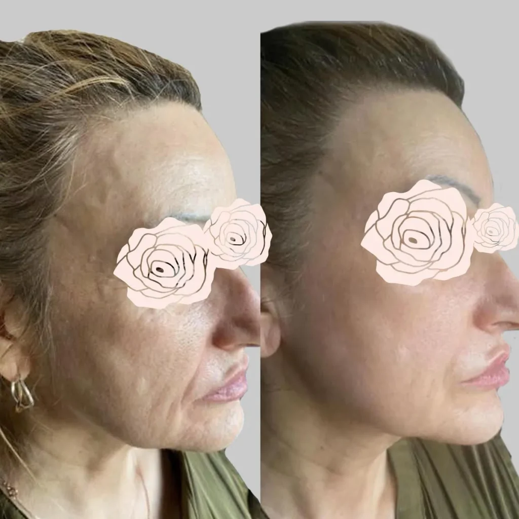before and after 13