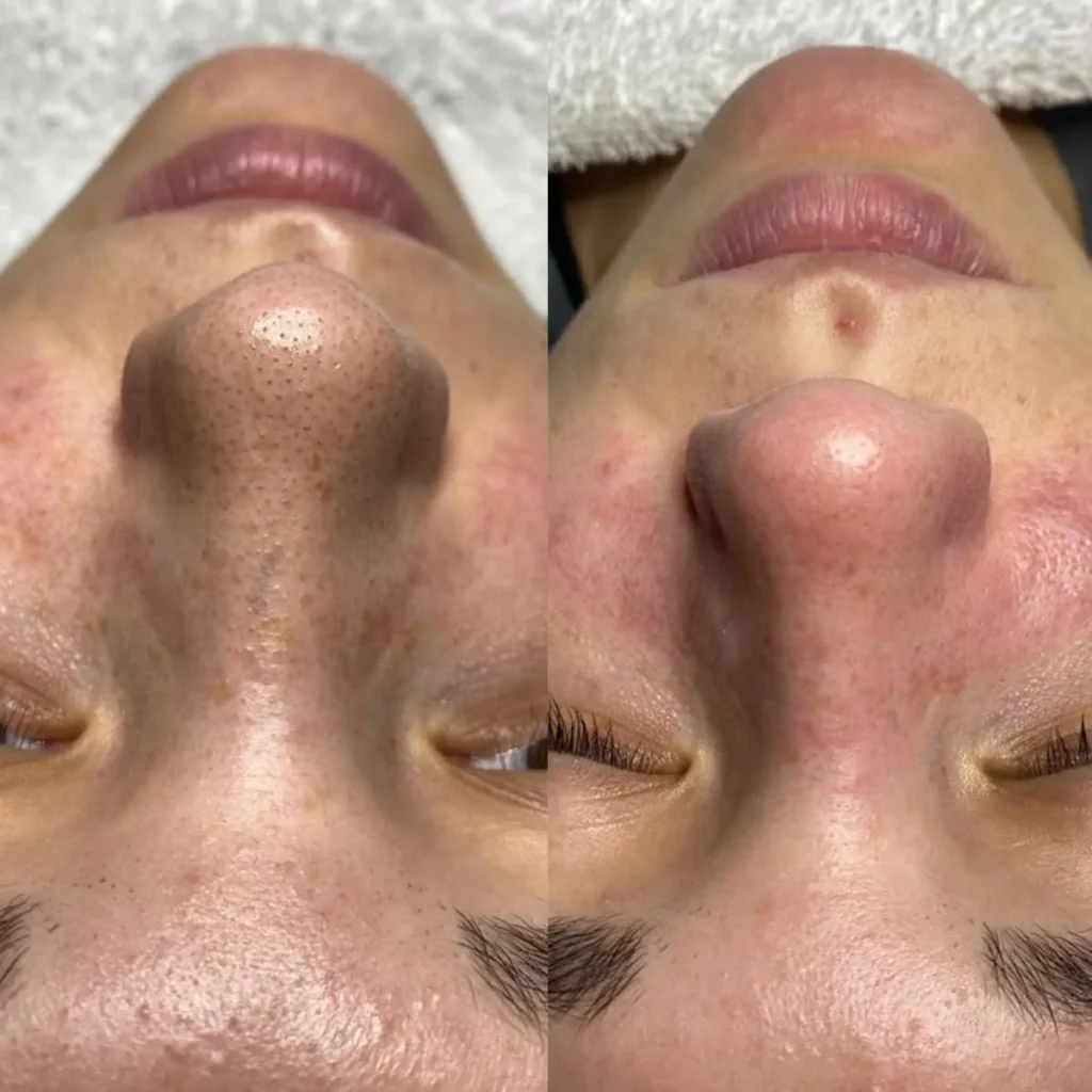 before and after 14