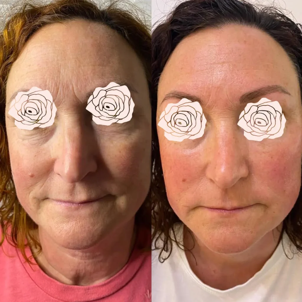 before and after 15