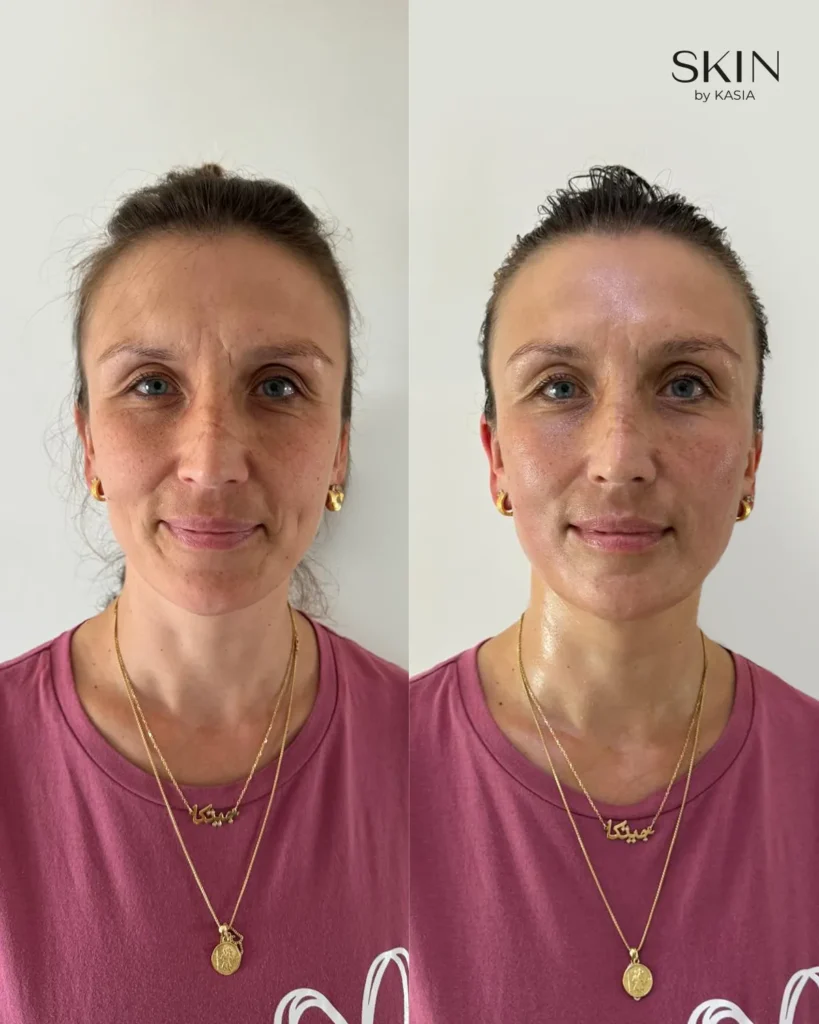 before and after 17