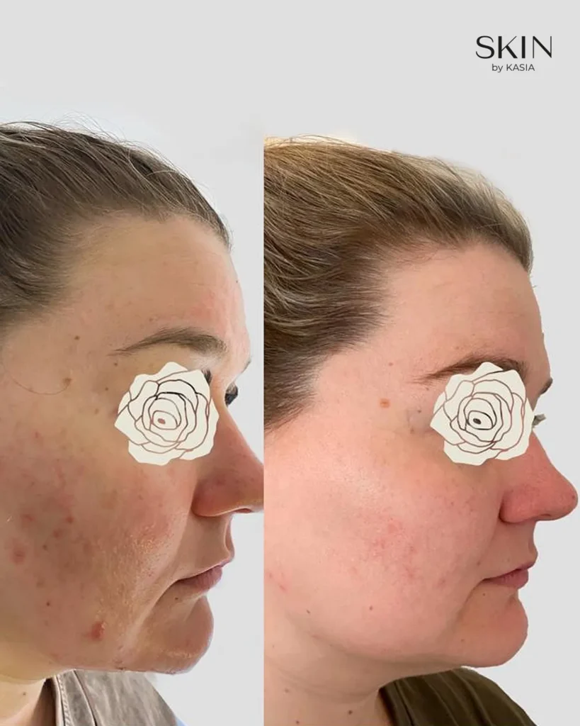 before and after 18