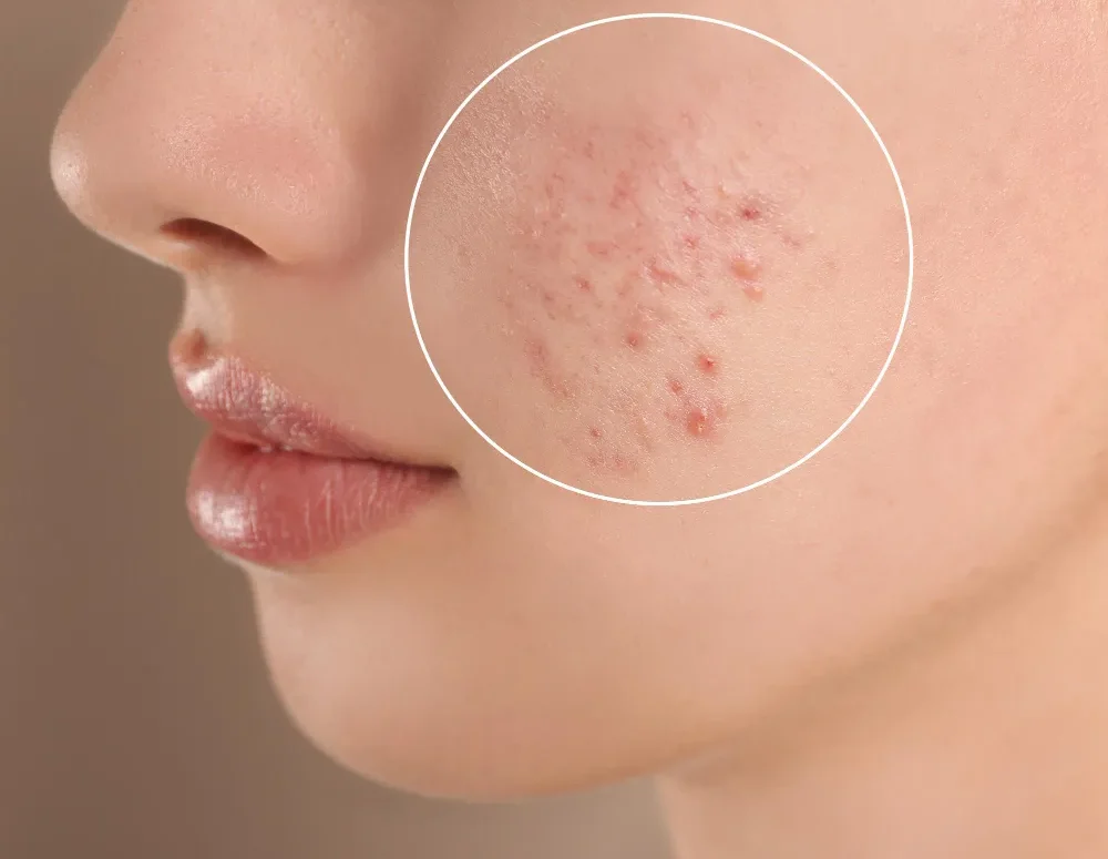 How to Reduce Acne Scars 2