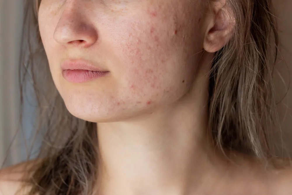 How to Reduce Acne Scars